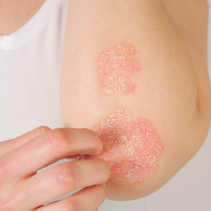 Managing Psoriasis the Natural Way: How Tallow Can Help