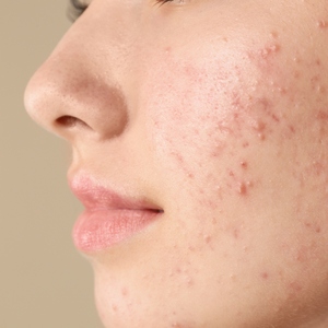 Natural Skincare Solutions for Acne-Prone Skin